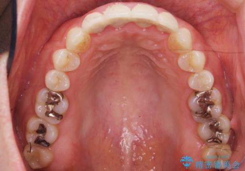 美容外科による不自然なかぶせもので、前歯がコンプレックスに。自然なセラミックにやりかえ 30代女性の治療前