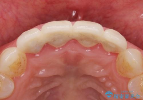 美容外科による不自然なかぶせもので、前歯がコンプレックスに。自然なセラミックにやりかえ 30代女性の治療前