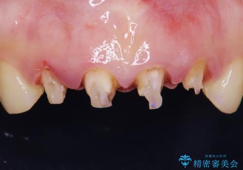 美容外科による不自然なかぶせもので、前歯がコンプレックスに。自然なセラミックにやりかえ 30代女性の治療前