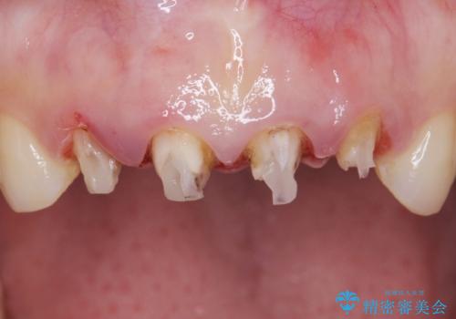 美容外科による不自然なかぶせもので、前歯がコンプレックスに。自然なセラミックにやりかえ 30代女性の治療中