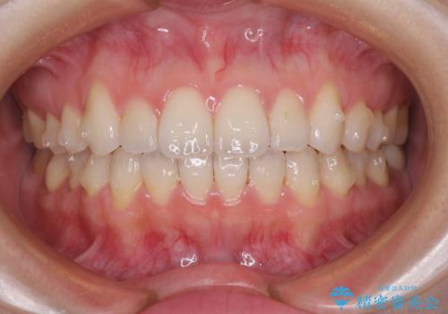 インビザライン・ライトにより後戻りの再矯正の治療中