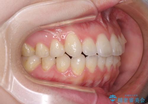 インビザライン・ライトにより後戻りの再矯正の治療中