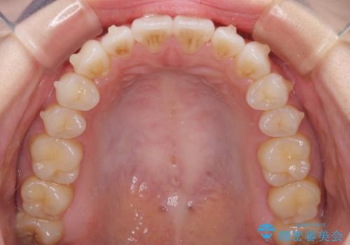 インビザライン・ライトにより後戻りの再矯正の治療中