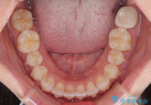 インビザライン・ライトにより後戻りの再矯正の治療中