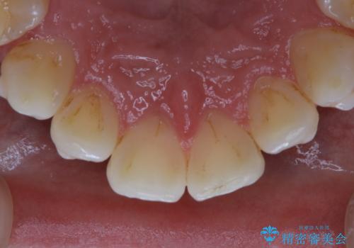 インビザラインでのマウスピース矯正中にPMTCの治療前