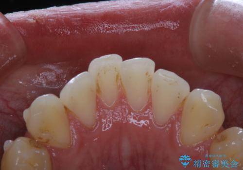 インビザラインでのマウスピース矯正中にPMTCの治療前