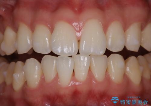 インビザラインでのマウスピース矯正中にPMTCの治療後