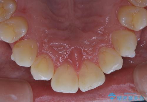 インビザラインでのマウスピース矯正中にPMTCの治療後