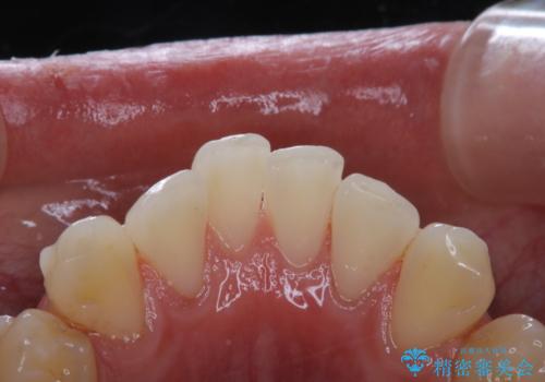 インビザラインでのマウスピース矯正中にPMTCの治療後