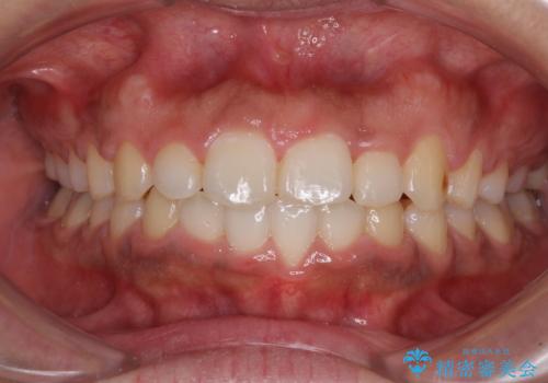 インビザラインが続けられない ワイヤー装置での矯正治療の症例 治療後