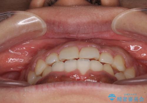 インビザラインが続けられない ワイヤー装置での矯正治療の治療後