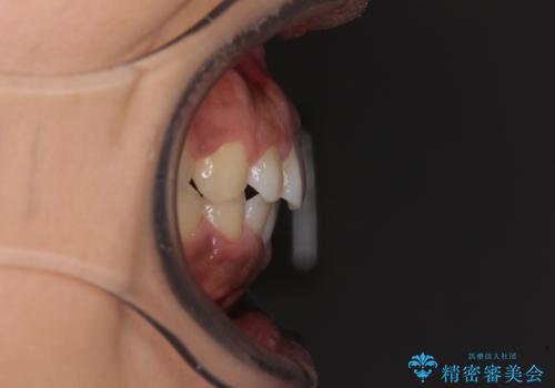 インビザラインが続けられない ワイヤー装置での矯正治療の治療後