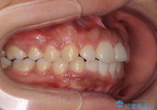 インビザラインが続けられない ワイヤー装置での矯正治療の治療後