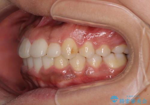 インビザラインが続けられない ワイヤー装置での矯正治療の治療後
