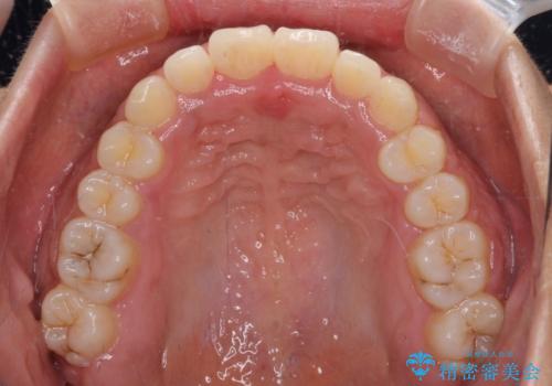 インビザラインが続けられない ワイヤー装置での矯正治療の治療後