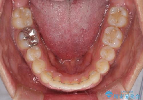 インビザラインが続けられない ワイヤー装置での矯正治療の治療後