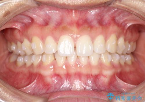すきっ歯のインビザラインによる目立たない矯正の治療中