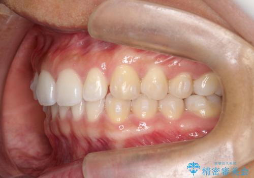すきっ歯のインビザラインによる目立たない矯正の治療中