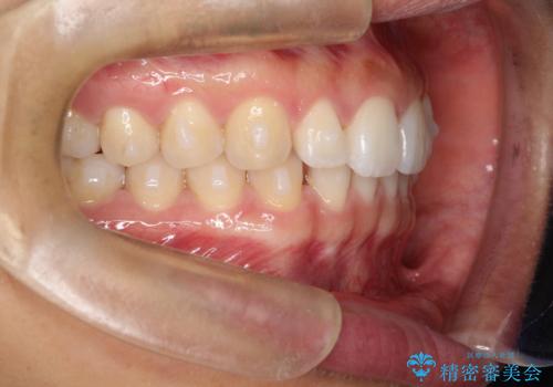 すきっ歯のインビザラインによる目立たない矯正の治療中