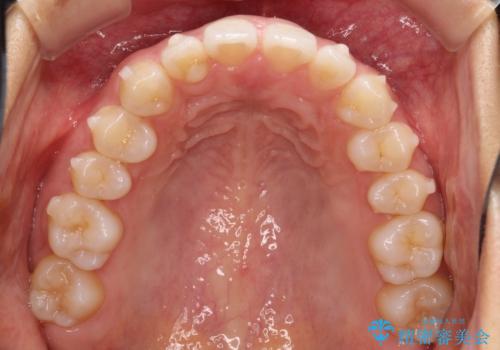 すきっ歯のインビザラインによる目立たない矯正の治療中