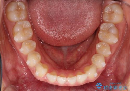 すきっ歯のインビザラインによる目立たない矯正の治療中