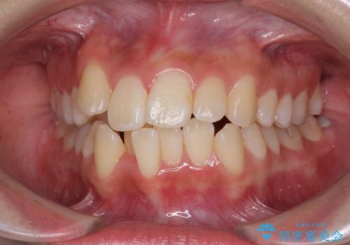 前歯の正中のズレを改善　目立たないワイヤー装置での抜歯矯正の症例 治療前