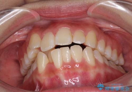 前歯の正中のズレを改善 目立たないワイヤー装置での抜歯矯正の治療前