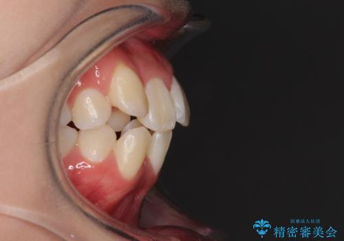 前歯の正中のズレを改善 目立たないワイヤー装置での抜歯矯正の治療前