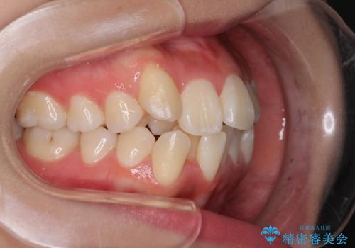 前歯の正中のズレを改善 目立たないワイヤー装置での抜歯矯正の治療前
