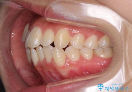前歯の正中のズレを改善　目立たないワイヤー装置での抜歯矯正の治療前