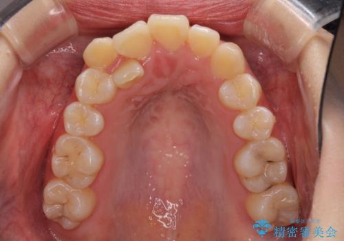 前歯の正中のズレを改善 目立たないワイヤー装置での抜歯矯正の治療前
