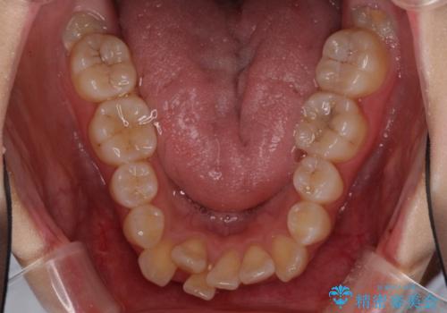 前歯の正中のズレを改善 目立たないワイヤー装置での抜歯矯正の治療前