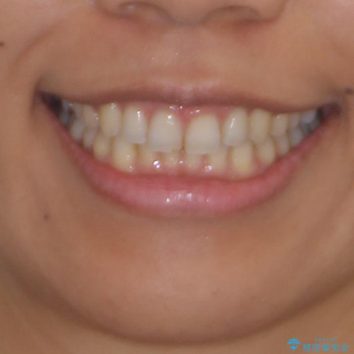 受け口傾向の前歯　すきっ歯の改善の治療後（顔貌）