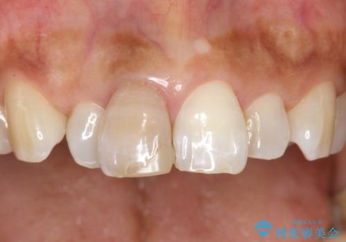 前歯の色が気になる、オールセラミッククラウンによる治療の治療前