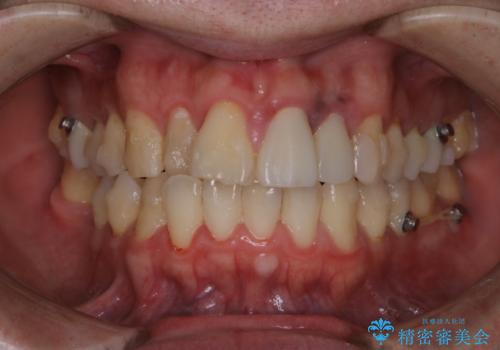 インビザラインで歯科矯正治療を行っている方のPMTCの治療前
