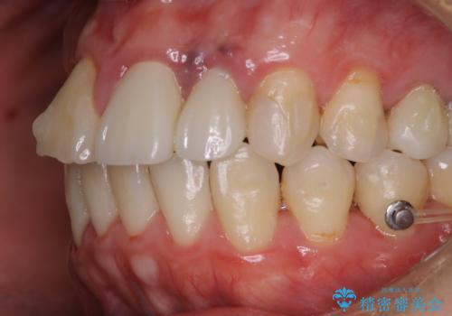 インビザラインで歯科矯正治療を行っている方のPMTCの治療前