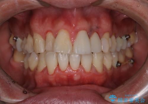 インビザラインで歯科矯正治療を行っている方のPMTCの治療後