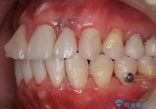 インビザラインで歯科矯正治療を行っている方のPMTCの治療後