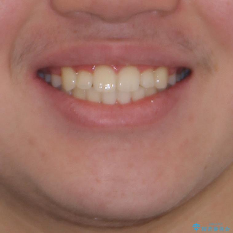 中学生のワイヤー矯正 クロスバイトを短期間で改善の治療後(顔貌)