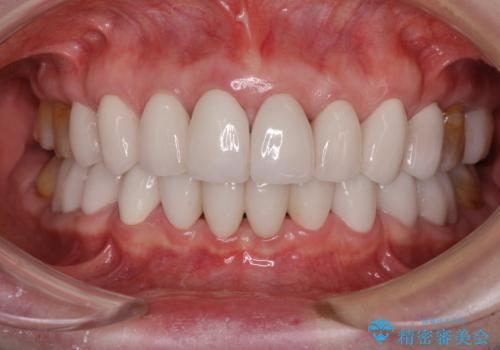 出っ歯を改善した後に真っ白な歯に　矯正歯科治療と審美歯科治療の症例 治療後