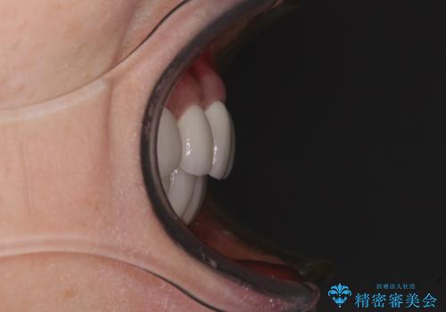 出っ歯を改善した後に真っ白な歯に 矯正歯科治療と審美歯科治療の治療後