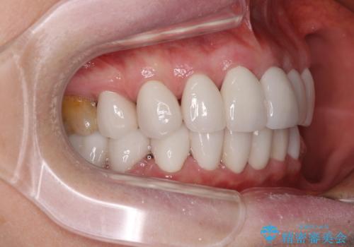 出っ歯を改善した後に真っ白な歯に 矯正歯科治療と審美歯科治療の治療後