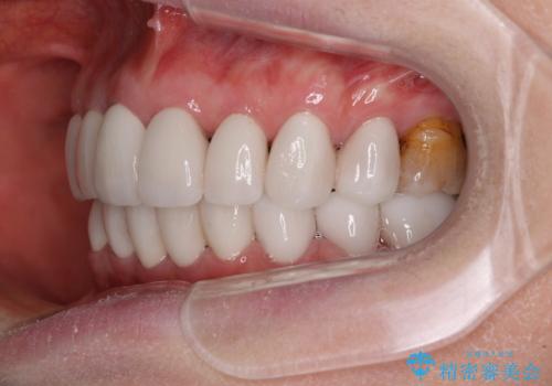 出っ歯を改善した後に真っ白な歯に　矯正歯科治療と審美歯科治療の治療後