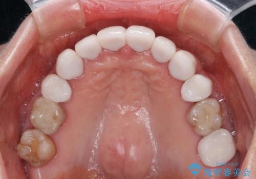 出っ歯を改善した後に真っ白な歯に 矯正歯科治療と審美歯科治療の治療後