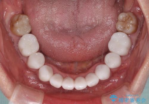 出っ歯を改善した後に真っ白な歯に 矯正歯科治療と審美歯科治療の治療後