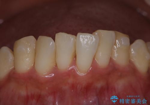 invisalign治療中にPMTCできれいな口元にの症例 治療前