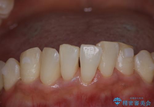 invisalign治療中にPMTCできれいな口元にの症例 治療後