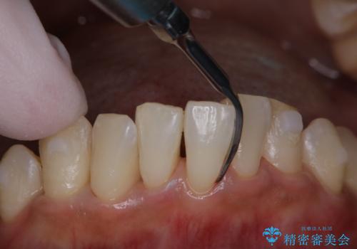 invisalign治療中にPMTCできれいな口元にの治療中