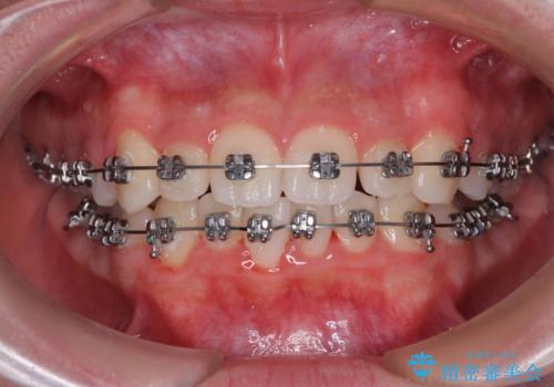 中学生のワイヤー矯正 クロスバイトを短期間で改善の治療中