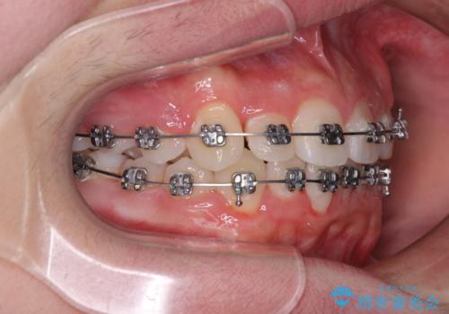 中学生のワイヤー矯正 クロスバイトを短期間で改善の治療中